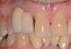 Fig 19. In 2016, downward growth of tooth No. 8 could be observed with uneven gingival margins of Nos. 8 and 9.