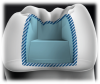 Fig 2. Illustration highlighting the most vulnerable area prone to recurrent decay in Class II restorations: the proximal box. Adapting materials well in this area can be challenging, which is why flowable bulk-fill dentin replacement composites are desirable.