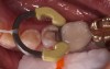 Fig 14. The defective restoration was removed; a sectional ring was placed to ensure good, tight contact when placing the lower viscosity bulk fill, as well as ideal separation of tooth structure for proper adaptation; glass ionomer was placed for pulpal protection.