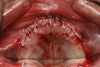 Fig 2. Sutures with primary closure.