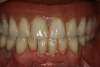 Fig 5. Final set and balanced occlusion.