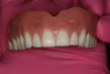 Fig 14. Existing denture and preparation of flanges prior to hard reline.