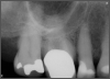 Fig 7. Bruxism.