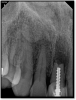 Fig 13. A good root canal may have been absorbed.