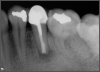 Fig 15. Postoperative radiograph.