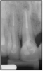 Fig 17. A case with a good fiber post on the lateral that could be longer.