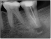 Fig 18. A case where the post was essentially useless and not congruent with the walls of the tooth.
