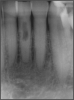 Fig 22. Internal resorption.