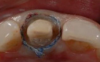 Fig 5. Margin after removal of retraction cord.