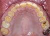 Fig 3. Preoperative occlusal view of maxillary arch.