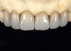 Fig 7. Full-contour monolithic high-translucent zirconia crowns for restorations for maxillary anterior teeth on the master cast.
