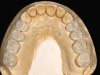 Fig 9. Occlusal view of posterior monolithic high-translucent zirconia restorations on the model.
