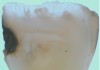 Fig 1. Ground section of a primary incisor with arrested caries lesion after SDF treatment: arrested caries that had SDF treatment. (image from Chu and Lo, 2008, ref 20 [reprinted with approval])