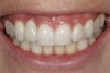 Fig 3. A patient presented with a high smile line and midfacial recession of the maxillary right lateral incisor as evidenced by the increased tooth length compared with the contralateral lateral incisor.