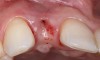 Fig 7. The gingiva was allowed to grow over the cover screw for a 2- to 3-week period. The soft-tissue shape was still deficient and would require a secondary augmentation procedure.