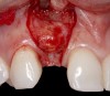 Fig 8. A subepithelial connective tissue graft was placed.