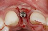 Fig 9. After 3 months of healing, the implant was uncovered. A crestal incision was made with a palatal bias and rolled to the labial side to increase the soft tissue to the facial aspect.
