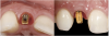 Fig 11. A custom alloy-based (semi-noble metal) abutment was fabricated. Metallic alloy was selected due to the compromise in abutment diameter as well as the severe angulation of the implant (left), lending to a thin facial abutment thickness of material for strength (right).