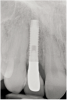 Fig 13. The final radiograph of the seated crown showing a healthy bone level around the implant.