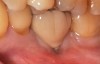 Fig 15. The implant-supported restoration of tooth No. 19 presented with a lack of attached keratinized gingiva, shallow buccal vestibule, and 2 mm of buccal recession.