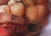 Fig 22. Copious irrigation with dilute hydrogen peroxide was used to chemically detoxify the surface of the implant and the bony defect.