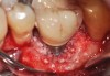 Fig 23. Fill of the infrabony defect with bone xenograft.