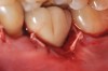 Fig 25. The flap sutured back in place.