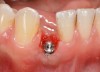 Fig 34. A surgical cover screw was placed in an attempt to decoronate the implant and gain soft-tissue coverage in situ.