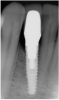 Fig 46. The post-treatment radiograph showing a healthy stable implant and restoration.