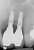 Fig 51. Radiograph of implants placed with insufficient inter-implant distance in Figure 49 and Figure 50 with attachment loss.