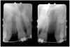 Figure 1  Pretreatment radiographs revealed convergent roots for the right canine and right central.