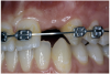 Figure 2b  Pretreatment buccal views showed (A) root convergence, (B) a difference in clinical appearance of the left lateral, and (C) significant crestal width of keratinized tissue.