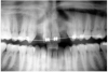 Figure 3  After orthodontic therapy, the radiograph did not provide enough diagnostic information to determine if implants could be placed.