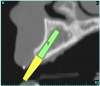 Figure 4a  CT scan data was input into the treatment-planning software, which allowed (A) placement of a simulated implant and (B) the determination of the “zone” for proper placement.