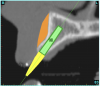 Figure 5b  The software (A) revealed a thinner facial-lingual crestal dimension, and (B) allowed a simulated bone graft to be placed.