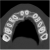 Figure 6a  By slicing the maxilla axially, the images revealed (A) the differing morphology of the central incisors, canines, premolar, and molar roots, and (B) the left simulated implant seen encroaching on the adjacent lamina dura.