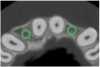 Figure 6b  By slicing the maxilla axially, the images revealed (A) the differing morphology of the central incisors, canines, premolar, and molar roots, and (B) the left simulated implant seen encroaching on the adjacent lamina dura.