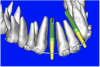 Figure 9c  Virtual implants were placed to determine the appropriate shape and type for the available space; in this case a tapered design allowed for adequate mesial-distal distance between adjacent roots.