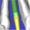 Figure 11a  By zooming in on the digital image, the implant-to-tooth distances can be assessed at the (A) crest and the (B) apex.