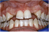 Figure 13a  Before implant surgery, the orthodontic brackets were removed, revealing (A) the position of the centrals, and (B, C) the anatomical variations of the crestal tissue and lack of interdental papilla.