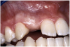 Figure 13b  Before implant surgery, the orthodontic brackets were removed, revealing (A) the position of the centrals, and (B, C) the anatomical variations of the crestal tissue and lack of interdental papilla.