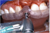 Figure 15b  A surgical template was derived from the final treatment plan created in the software, which facilitated (A) the drilling sequence and (B) precise location of placement.