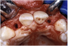 Figure 16a  After (A) the osteotomies were completed, (B) the implants were placed.