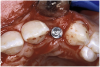 Figure 17a  By predetermining the necessary orientation of the restorative components, the implant’s antirotational hex was positioned correctly.