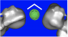 Figure 18a  The software allowed the implant’s antirotational hex to be positioned in the desired location and stock components to be evaluated.