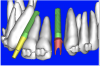 Figure 19a  A patient-specific abutment was designed in the software directly from the CT data.