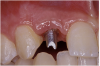 Figure 20a  The patient-specific, computer-milled abutments were placed.