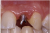 Figure 20b  The patient-specific, computer-milled abutments were placed.