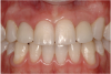 Figure 22a  The final restorations are indistinguishable from the surrounding dentition, demonstrating good emergence and re-creation of the interdental papillae.