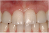 Figure 22b  The final restorations are indistinguishable from the surrounding dentition, demonstrating good emergence and re-creation of the interdental papillae.